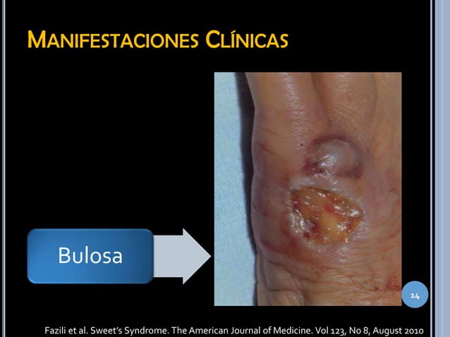 Pioderma gangrenoso