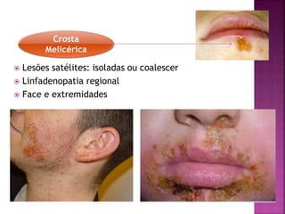 Crosta
Melicérica
 Lesões satélites: isoladas ou coalescer
 Linfadenopatia regional
 Face e extremidades
 