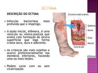 DESCRIÇÃO DO ECTIMA
 Infecção bacteriana mais
profunda que o impetigo.
 A lesão inicial, efêmera, é uma
vesícula ou vésico-pústula que
evolui com formação de úlcera
superficial que logo forma
crosta seca, dura e aderente.
 As crianças são mais sujeitas e
ocorre preferencialmente nos
membros inferiores, havendo
uma ou mais lesões.
 Podem curar com ou sem
cicatrização.
 