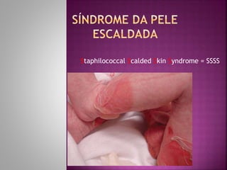 Staphilococcal Scalded Skin Syndrome = SSSS
 