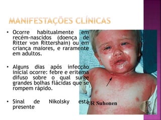 • Ocorre habitualmente em
recém-nascidos (doença de
Ritter von Rittershain) ou em
criança maiores, e raramente
em adultos.
• Alguns dias após infecção
inicial ocorre: febre e eritema
difuso sobre o qual surge
grandes bolhas flácidas que se
rompem rápido.
• Sinal de Nikolsky está
presente
 