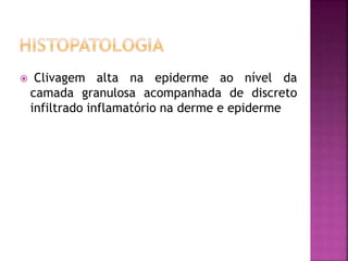  Clivagem alta na epiderme ao nível da
camada granulosa acompanhada de discreto
infiltrado inflamatório na derme e epiderme
 