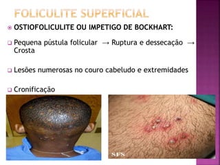  OSTIOFOLICULITE OU IMPETIGO DE BOCKHART:
 Pequena pústula folicular → Ruptura e dessecação →
Crosta
 Lesões numerosas no couro cabeludo e extremidades
 Cronificação
 