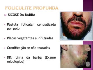  SICOSE DA BARBA
 Pústula folicular centralizada
por pelo
 Placas vegetantes e infiltradas
 Cronificação se não tratadas
 DD: tinha da barba (Exame
micológico)
 