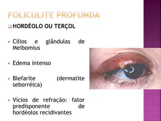  HORDÉOLO OU TERÇOL
 Cílios e glândulas de
Meibomius
 Edema intenso
 Blefarite (dermatite
seborréica)
 Vícios de refração: fator
predisponente de
hordéolos recidivantes
 