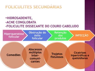 Hiperqueratose
folicular
Obstrução do
óstio
folicular
Retenção
dos
produtos
INFECÇÃO
Comedões
Abscessos
múltiplos
inter-
comuni-
cantes
Trajetos
fistulosos
Cicatrizes
hipertróficas e
queloidianas
 