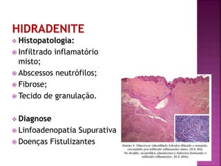  Histopatologia:
 Infiltrado inflamatório
misto;
 Abscessos neutrófilos;
 Fibrose;
 Tecido de granulação.
 Diagnose
 Linfoadenopatia Supurativa
 Doenças Fistulizantes
 