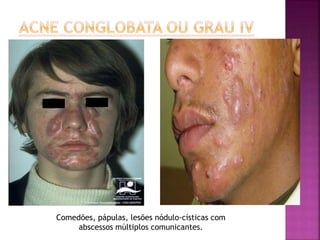 Comedões, pápulas, lesões nódulo-císticas com
abscessos múltiplos comunicantes.
 