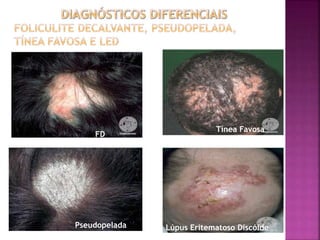 Pseudopelada
Tínea Favosa
FD
Lúpus Eritematoso Discóide
 