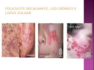 FD
LED Crônico
Lúpus Vulgar
 