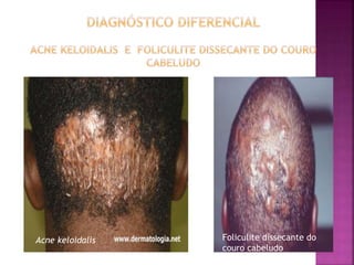 Foliculite dissecante do
couro cabeludo
Acne keloidalis
 