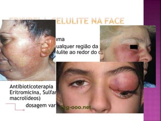  Quadros raros
 Surgem após trauma
 Localização em qualquer região da face,
eventualmente celulite ao redor do olho e a
periorbital.
 Em crianças  Haemophilus Influenzae
 Tratamento
Antibioticoterapia IV( Penicilina, Amoxicilina,
Eritromicina, Sulfametoxazol-trimetropim, outros
macrolídeos)
dosagem varia com a intensidade do quadro
 