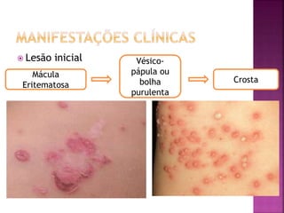  Lesão inicial
Mácula
Eritematosa
Vésico-
pápula ou
bolha
purulenta
Crosta
 