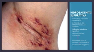 PIODERMITIS PRESENTACIÓN OFICIAL DERMATOLOGÍA .pptx