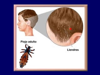 Liendres Piojo adulto 