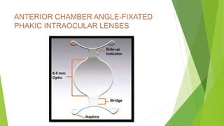 ANTERIOR CHAMBER ANGLE-FIXATED
PHAKIC INTRAOCULAR LENSES
 