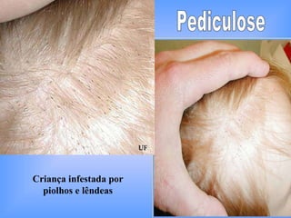 Criança infestada por piolhos e lêndeas Pediculose 