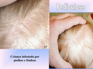 Criança infestada por
piolhos e lêndeas
 