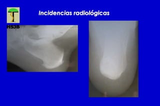 Incidencias radiológicas
 