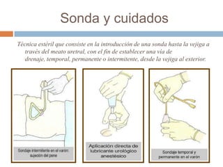 Sonda y cuidados
Técnica estéril que consiste en la introducción de una sonda hasta la vejiga a
través del meato uretral, con el fin de establecer una vía de
drenaje, temporal, permanente o intermitente, desde la vejiga al exterior.
 