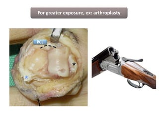 For greater exposure, ex: arthroplasty
PCL
 