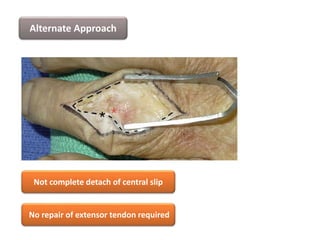 Alternate Approach
Not complete detach of central slip
No repair of extensor tendon required
 