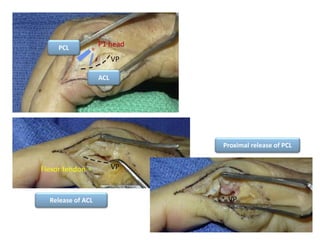 PCL
ACL
VP
P1 head
Release of ACL
Proximal release of PCL
VPFlexor tendon
VP
 