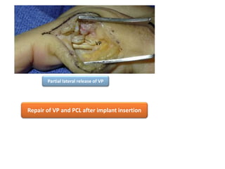 Partial lateral release of VP
Repair of VP and PCL after implant insertion
VP
 