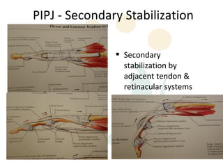 PIPJ - Secondary Stabilization

                Secondary
                 stabilization by
                 adjacent tendon &
                 retinacular systems
 