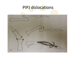 PIPJ dislocations
 
