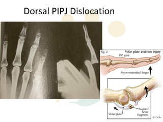 Dorsal PIPJ Dislocation
 