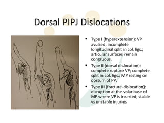 Dorsal PIPJ Dislocations
             Type I (hyperextension): VP
              avulsed; incomplete
              longitudinal split in col. ligs.;
              articular surfaces remain
              congruous.
             Type II (dorsal dislocation):
              complete rupture VP; complete
              split in col. ligs.; MP resting on
              dorsum of PP.
             Type III (fracture-dislocation):
              disruption at the volar base of
              MP where VP is inserted; stable
              vs unstable injuries
 