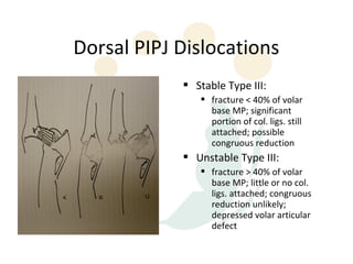 Dorsal PIPJ Dislocations
             Stable Type III:
                fracture < 40% of volar
                 base MP; significant
                 portion of col. ligs. still
                 attached; possible
                 congruous reduction
             Unstable Type III:
                fracture > 40% of volar
                 base MP; little or no col.
                 ligs. attached; congruous
                 reduction unlikely;
                 depressed volar articular
                 defect
 