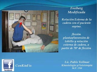 Sindrome del Piramidal o Piriforme