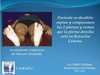 Sindrome del Piramidal o Piriforme