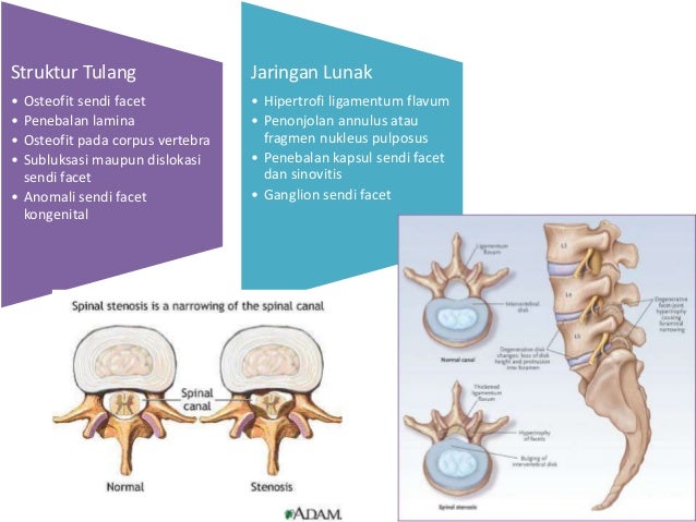Piriformis Syndrome, Lumbar Spinal Stenosis, Lumbar Facet 