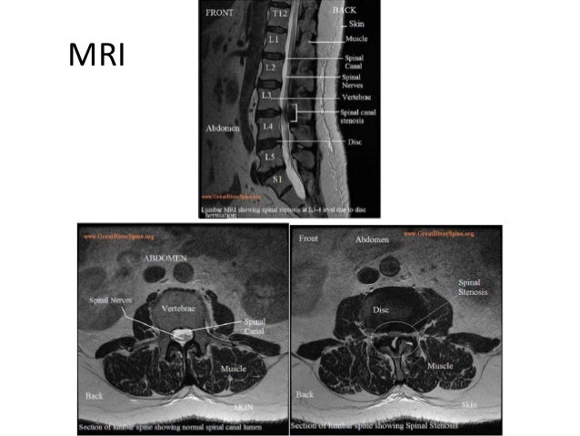 Piriformis Syndrome, Lumbar Spinal Stenosis, Lumbar Facet 