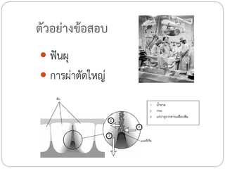 ตัวอย่างข้อสอบ
 ฟันผุ
 การผ่าตัดใหญ่

 