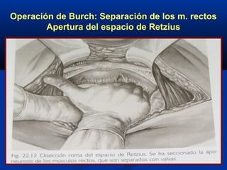 Operación de Burch: Separación de los m. rectos
Apertura del espacio de Retzius
 