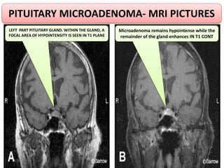 PITUITARY MICROADENOMA- MRI PICTURES
LEFT PART PITUITARY GLAND. WITHIN THE GLAND, A
FOCAL AREA OF HYPOINTENSITY IS SEEN IN...