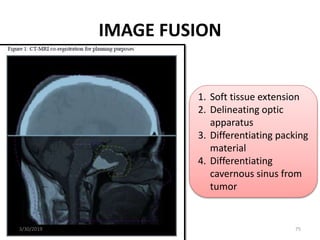 IMAGE FUSION
1. Soft tissue extension
2. Delineating optic
apparatus
3. Differentiating packing
material
4. Differentiatin...