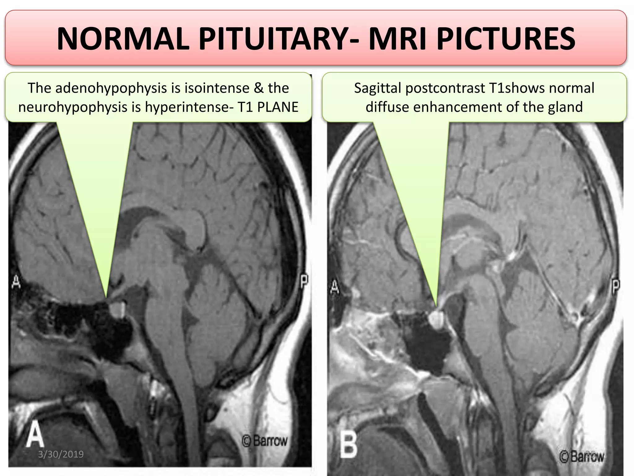PITUITARY ADENOMA RADIOTHERAPY PLANNING | PPTX