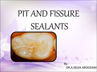 PIT AND FISSURE
SEALANTS
By
DR.A.SELVA AROCKIAM
 