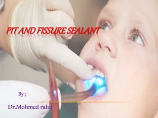PITANDFISSURESEALANT
By ;
Dr.Mohmed rahil
 