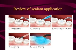 AGE RANGES FOR SEALANT APPLICATION:

3-4 YEARS- PRIMARY MOLARS

6-7 YEARS- 1ST PERMANENT MOLAR

11-13 YEARS- 2ND PERMAN...