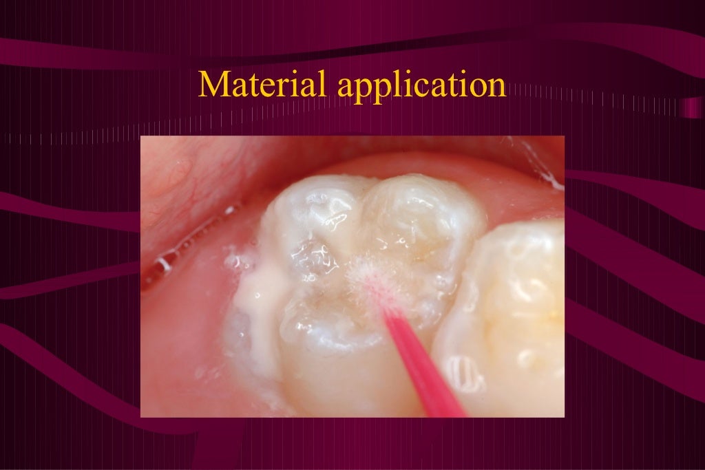 Pit and fissure sealants