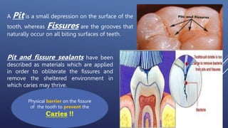Pit and Fissure Sealants Dr. Ali Mohammed | PPT