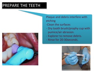 PREPARE THE TEETH
Plaque and debris interfere with
etching
-Clean the surfaces
- Dry tooth brush/prophy cup with
pumice/air abrasion.
- Explorer to remove debris.
- Rinse for 20-30seconds.
 