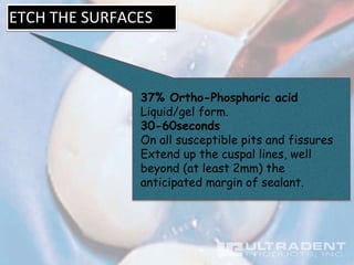 ETCH THE SURFACES
37% Ortho-Phosphoric acid
Liquid/gel form.
30-60seconds
On all susceptible pits and fissures
Extend up the cuspal lines, well
beyond (at least 2mm) the
anticipated margin of sealant.
 