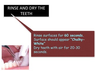 RINSE AND DRY THE
TEETH
Rinse surfaces for 60 seconds.
Surface should appear “Chalky-
White”
Dry teeth with air for 20-30
seconds.
 